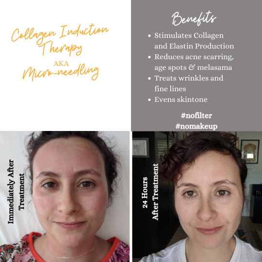 Before and after photo of a woman demonstrating benefits of microneedling